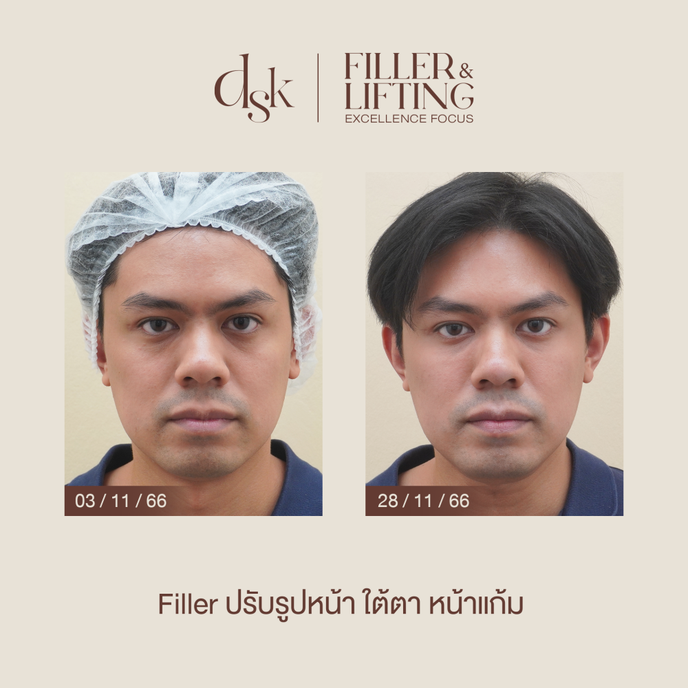 HN.S66-001259_ใต้ตา หน้าแก้ม 4cc_dr.gift