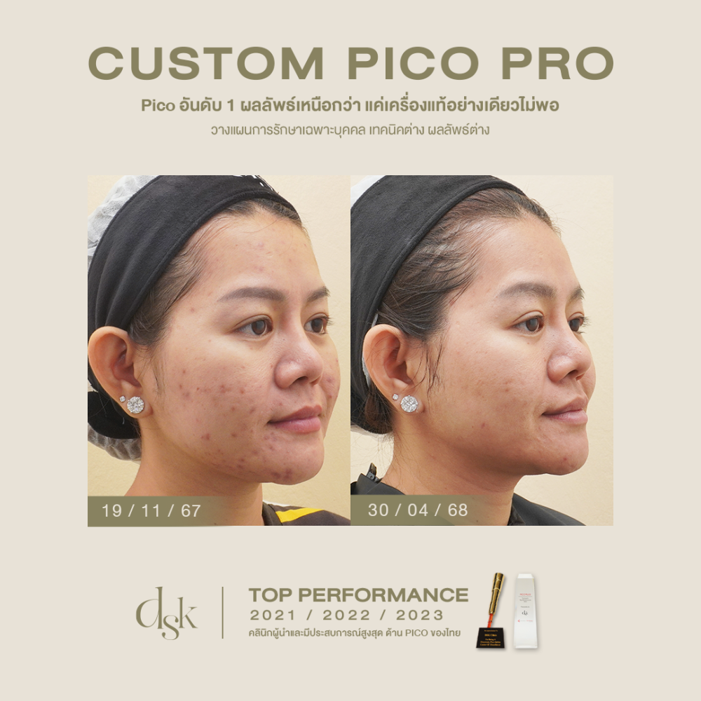 HN.S67-001891_Custompico 3ครั้ง