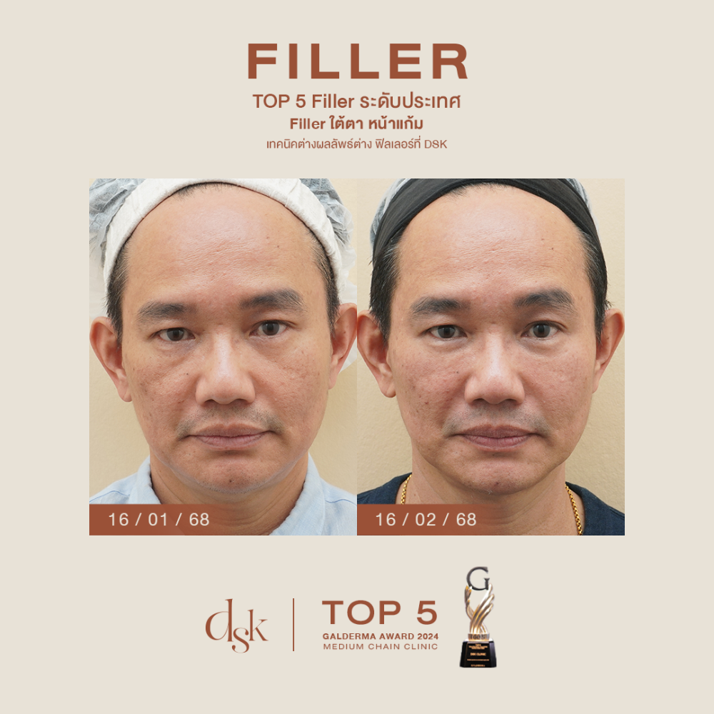 HN.S68-002529_filler ใต้ตา หน้าแก้ม dr.prince