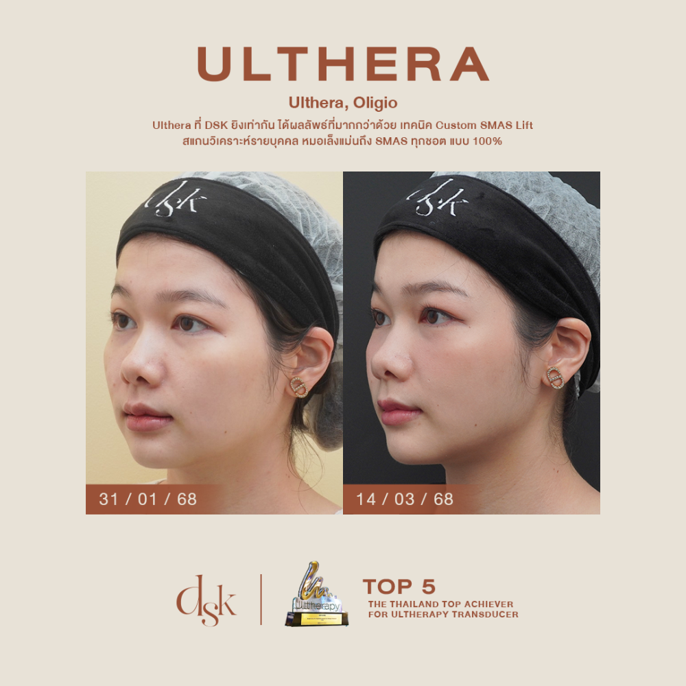 hn.B68-001686_ulthera,oligio_dr.sai