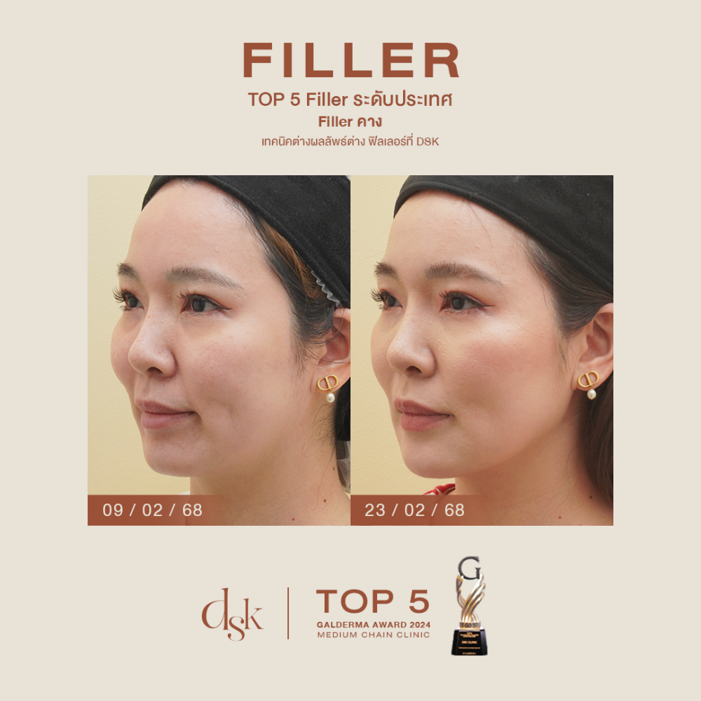 hn.B68-001722_filler คาง_dr.gift