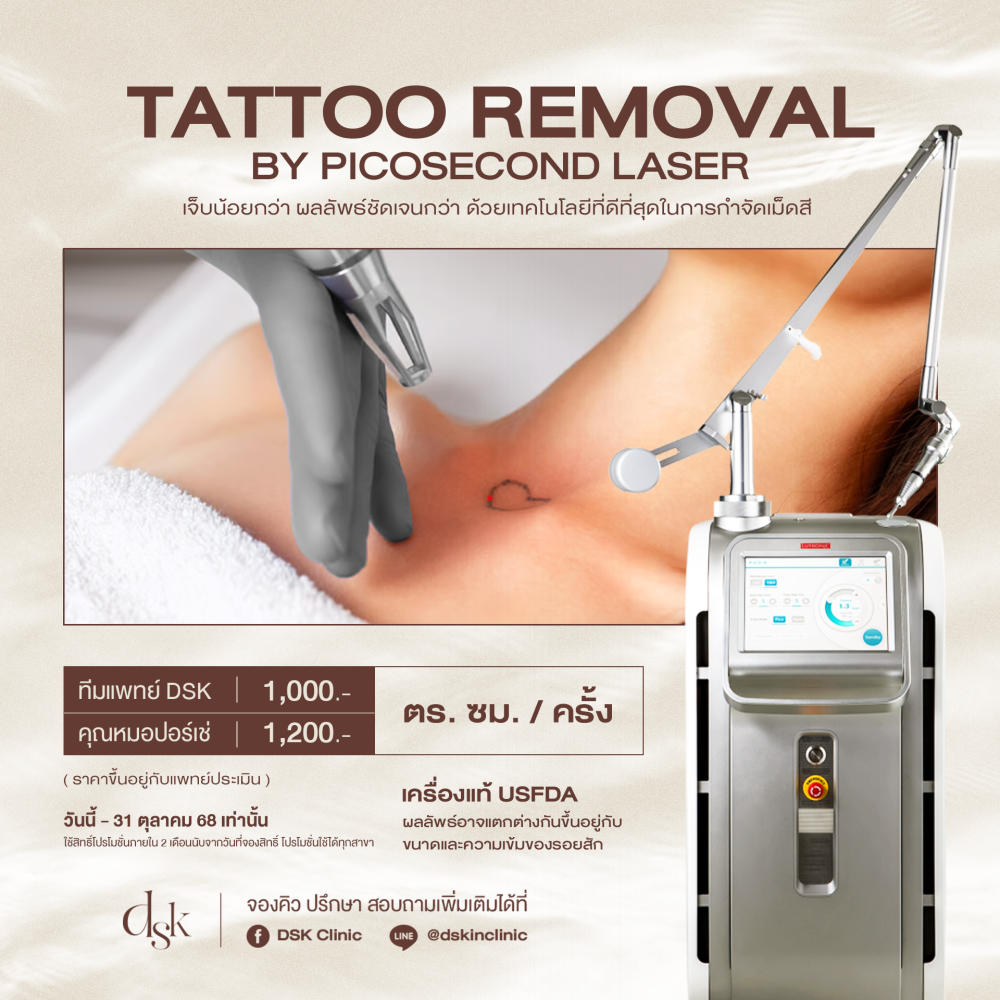 tattoo removal