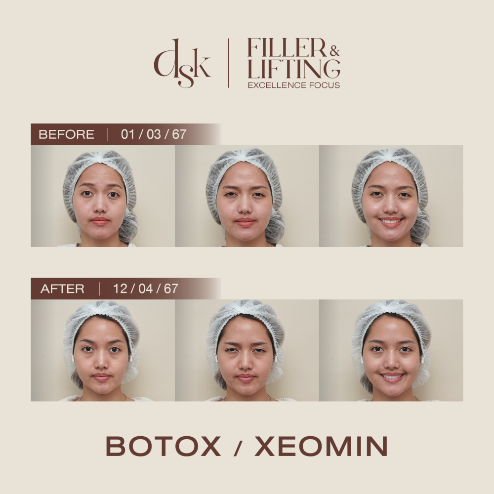 timelimit1y_from04_24_HN.R64-015389_Botox xeomin