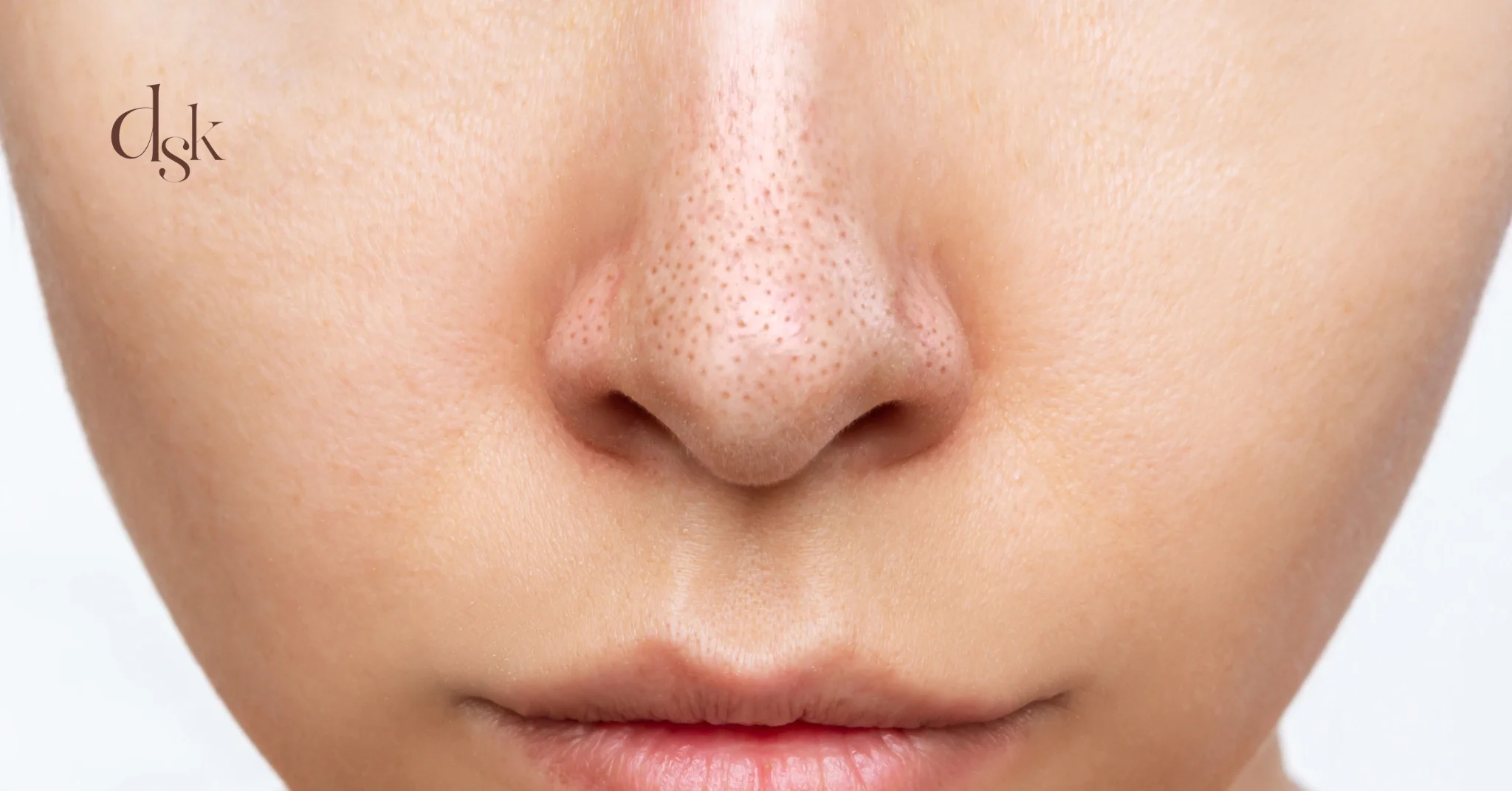 สาเหตุที่สิวขึ้นจมูก