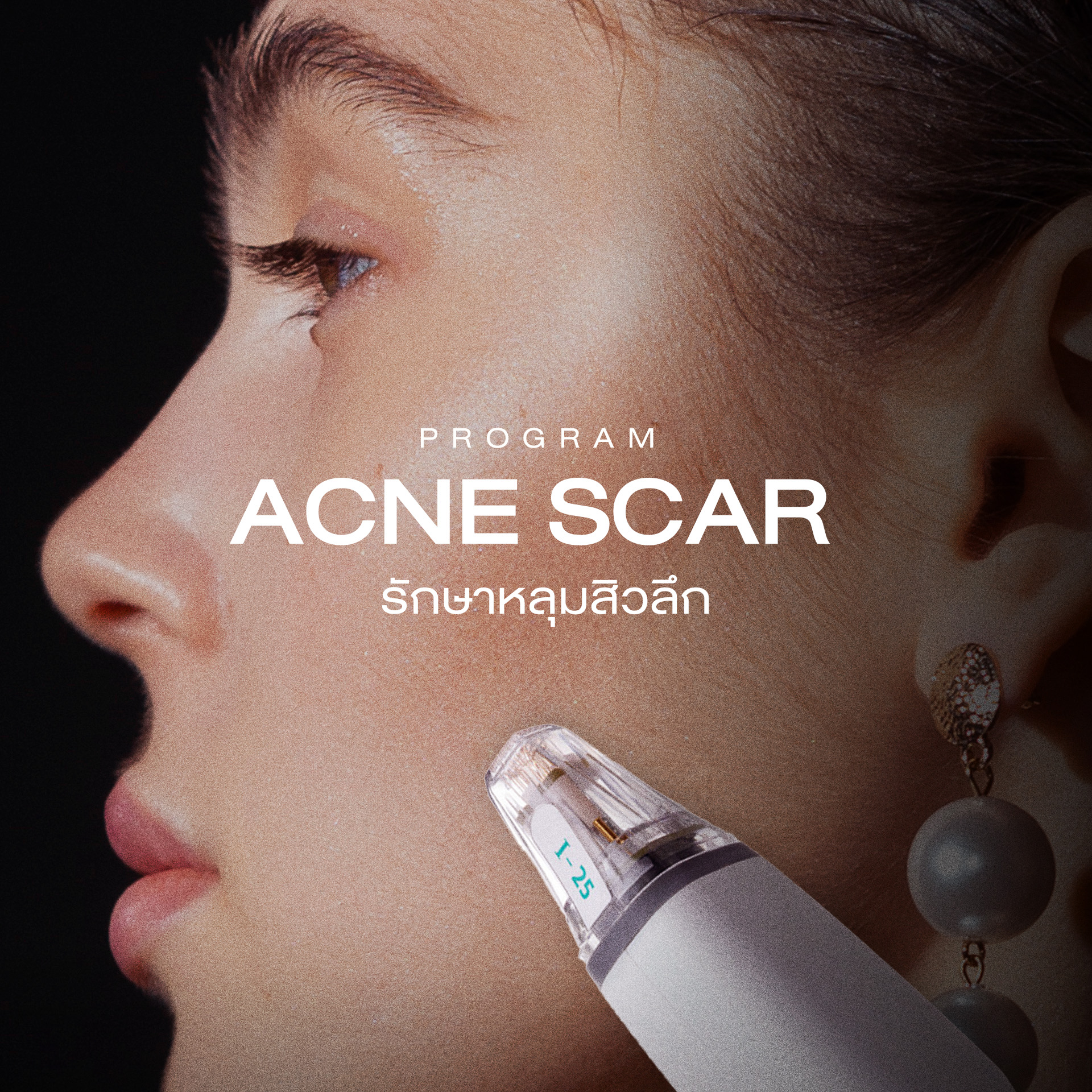 ศูนย์รักษาหลุมสิวครบวงจร