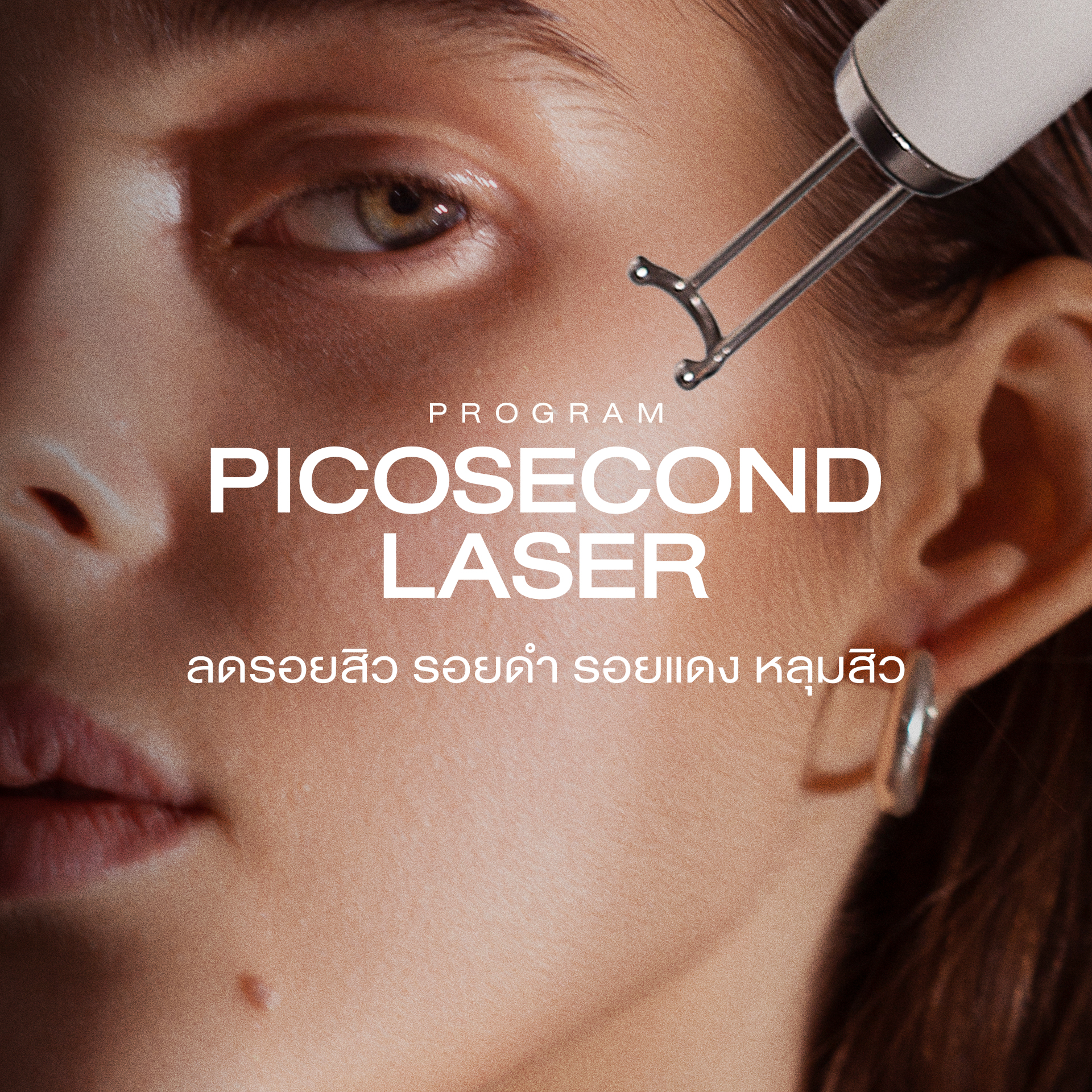 ลดรอยสิว รอยดำ รอยแดง